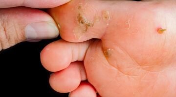 مرض عين السمك