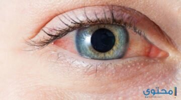 العيون بالأعشاب1