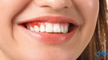 الضرس المحشو4