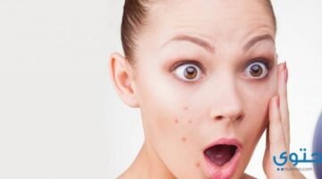 للتخلص حب الشباب2